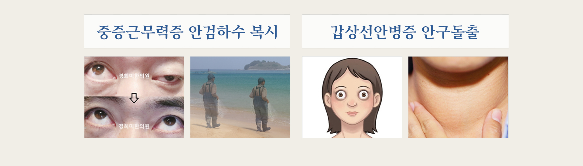 중증근무력증
