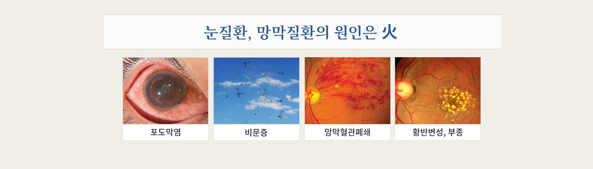 눈질환