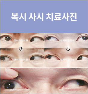 복시 치료사례