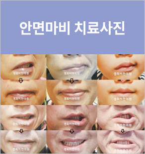 안면마비 치료사례