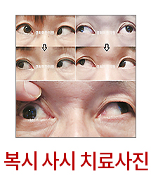 ���� ġ����