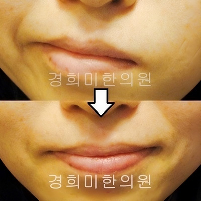 전후사진 이미지4