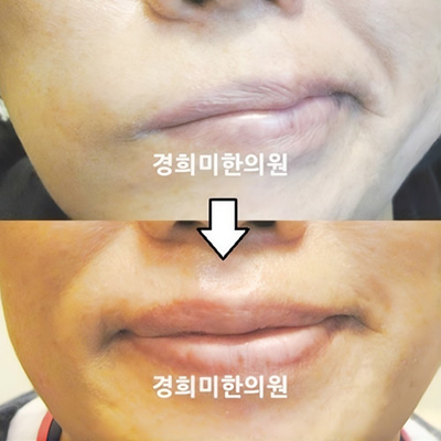 전후사진 이미지5