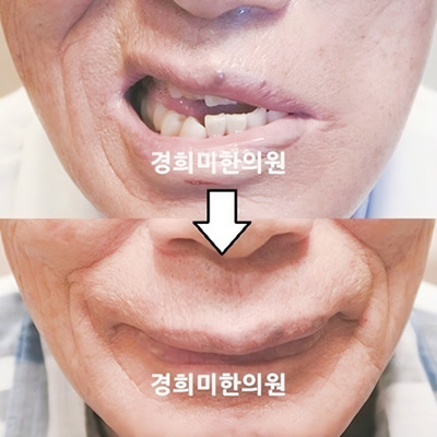 전후사진 이미지6