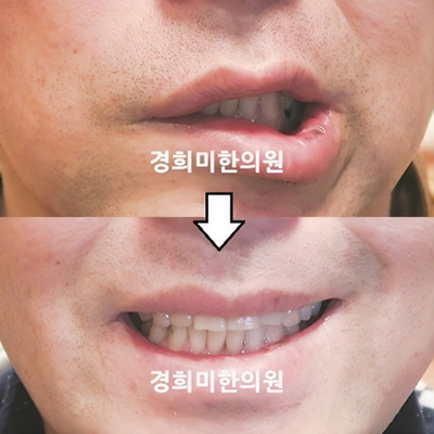 전후사진 이미지7
