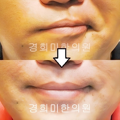 전후사진 이미지8