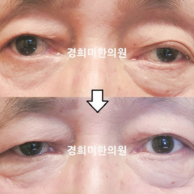 전후사진 이미지5