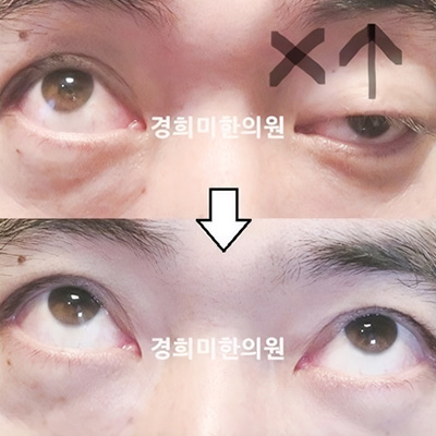 전후사진 이미지1