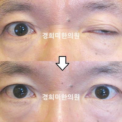 전후사진 이미지2
