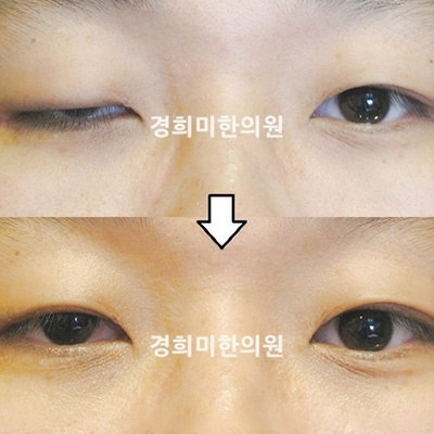 전후사진 이미지8