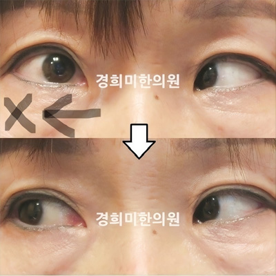 전후사진 이미지1