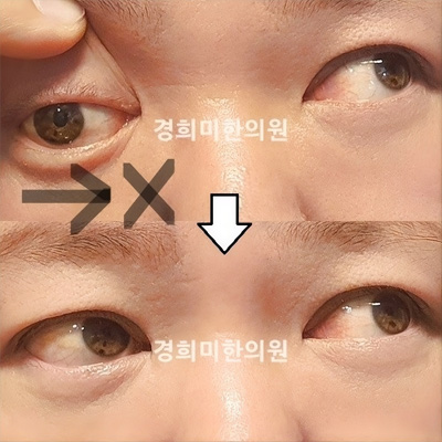 전후사진 이미지5