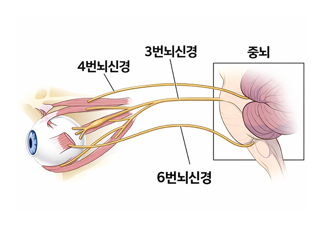 원인 이미지4