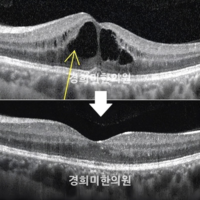 전후사진 이미지1
