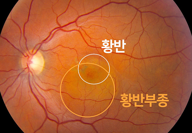 원인 이미지1