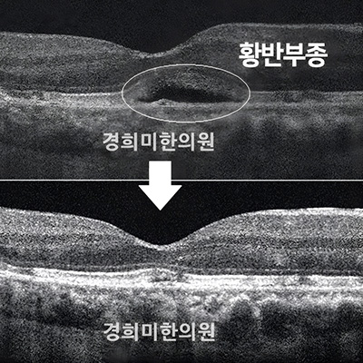 전후사진 이미지1