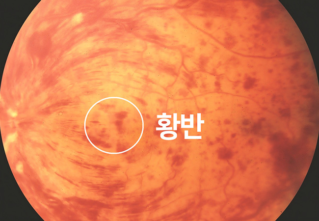 증상 이미지1