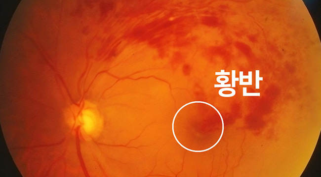 증상 이미지2