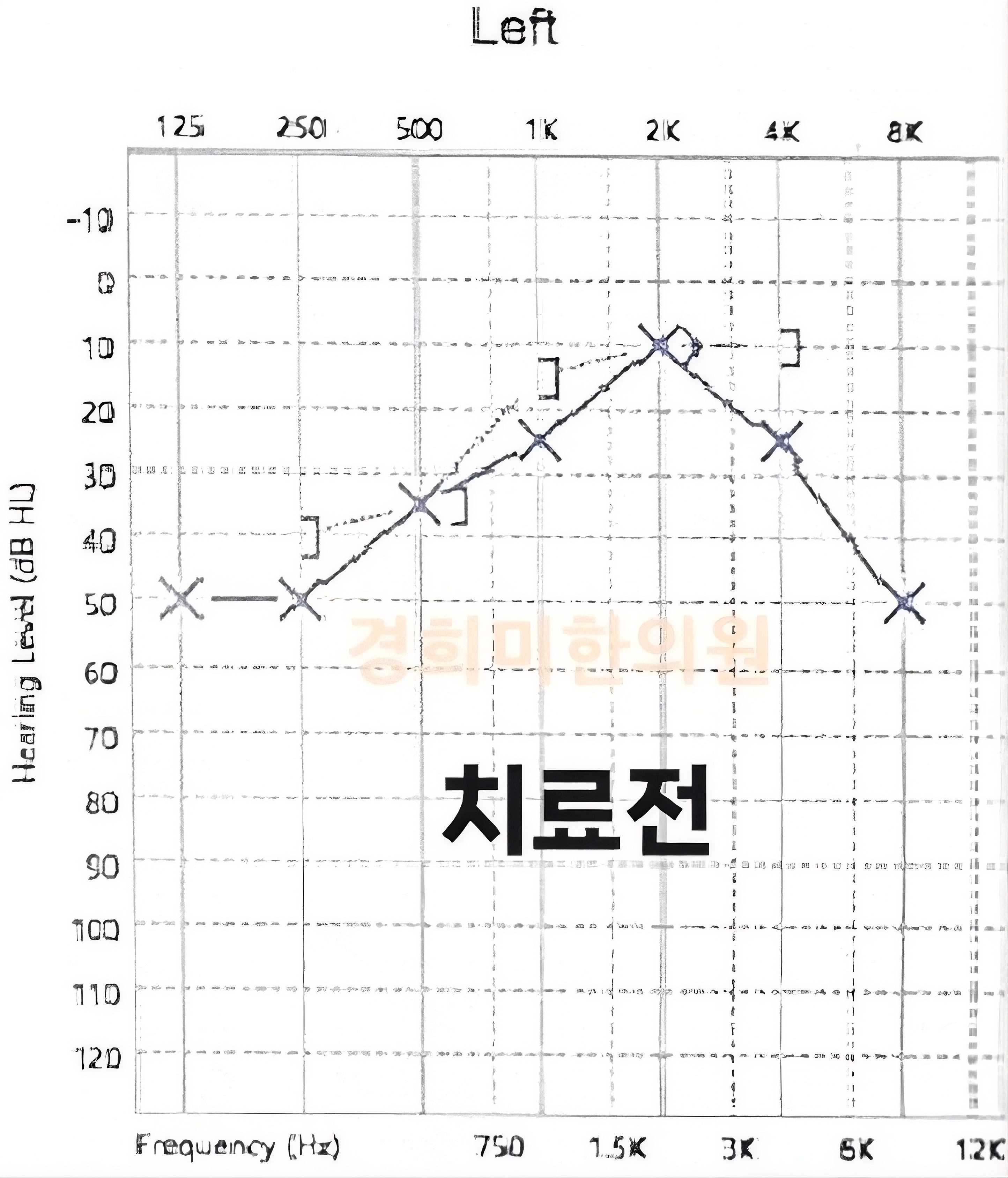 2-돌발성난청 임호열1.jpg