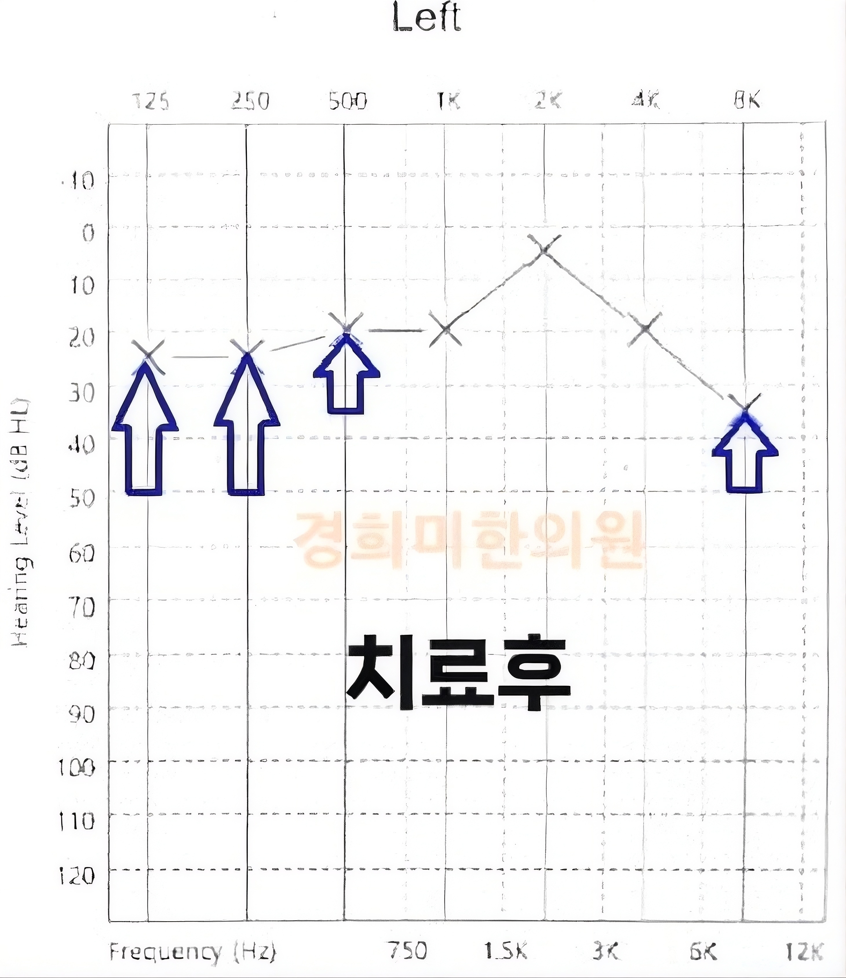 2-돌발성난청 임호열2.jpg