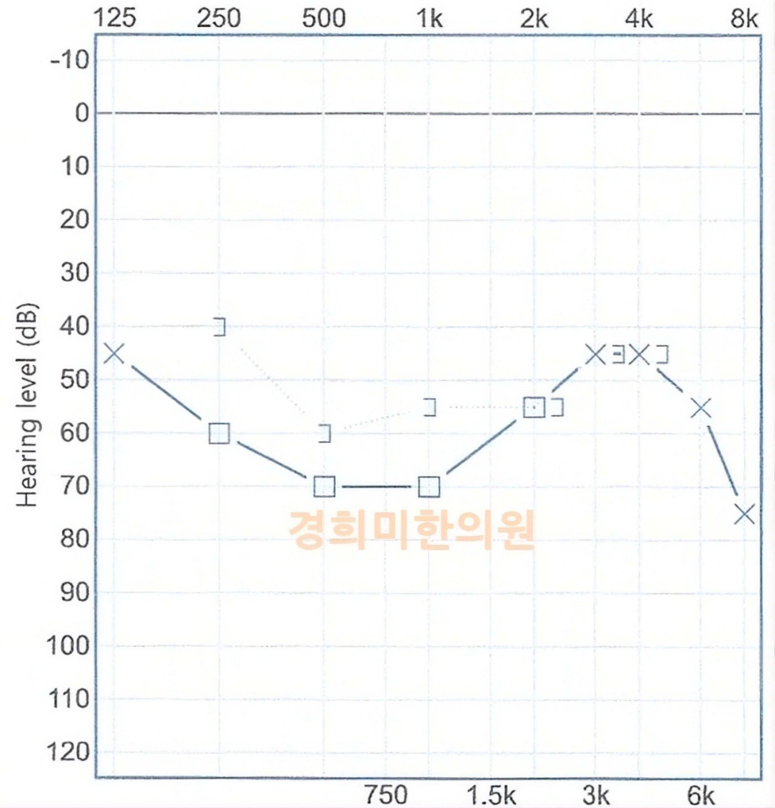 3-돌발성난청 이수월1.jpg