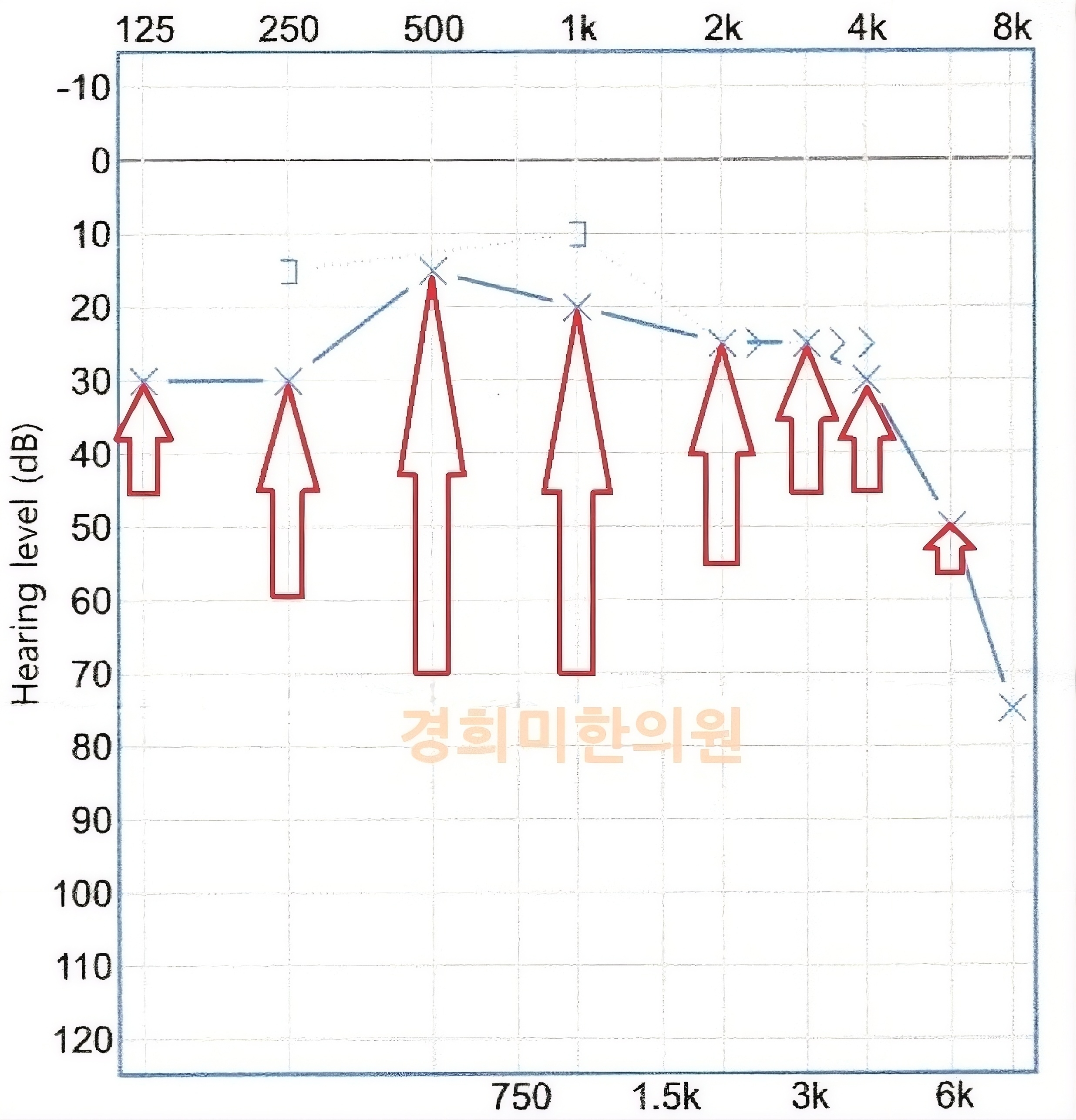 3-돌발성난청 이수월2.jpg