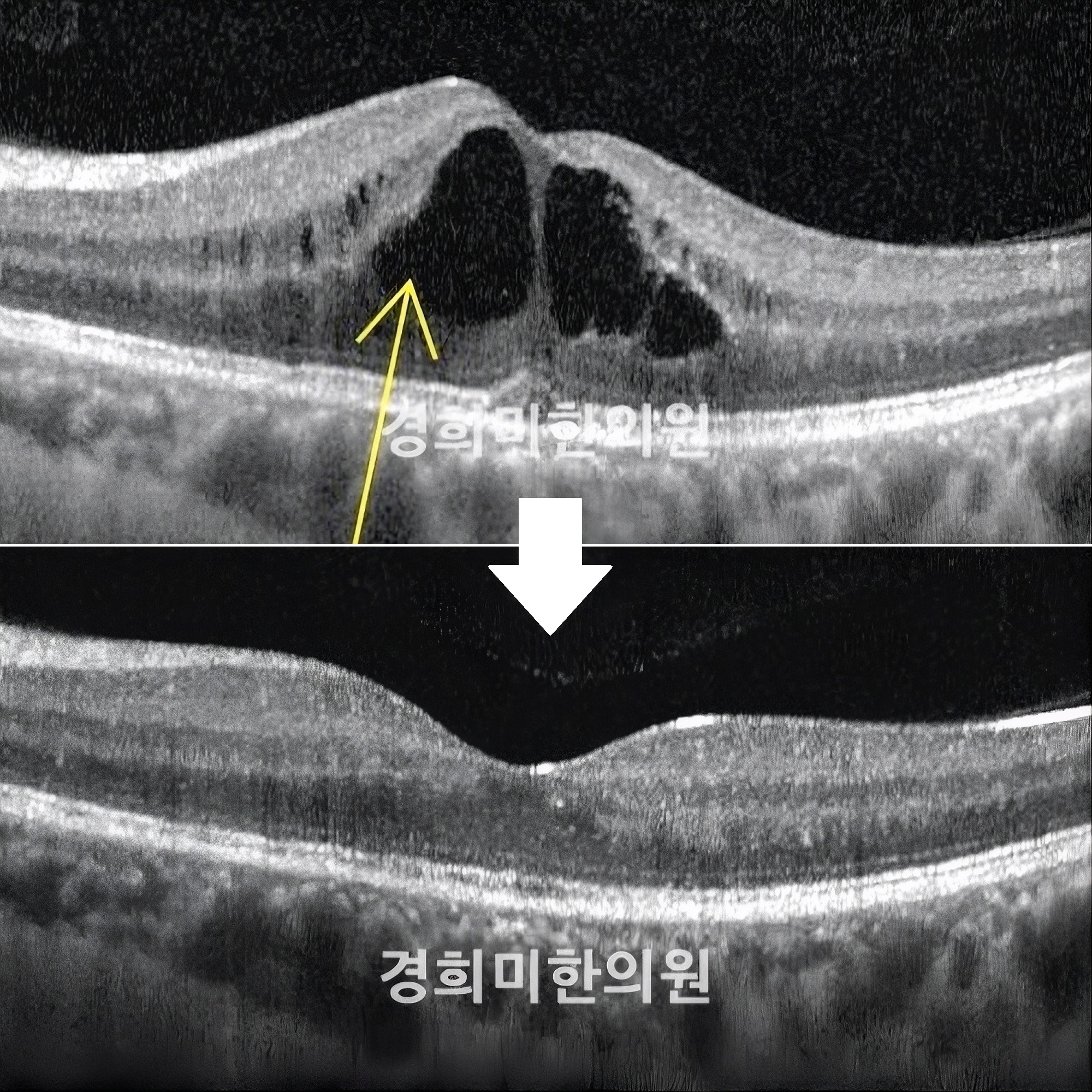 5-황반부종 이정하1(좌안).jpg