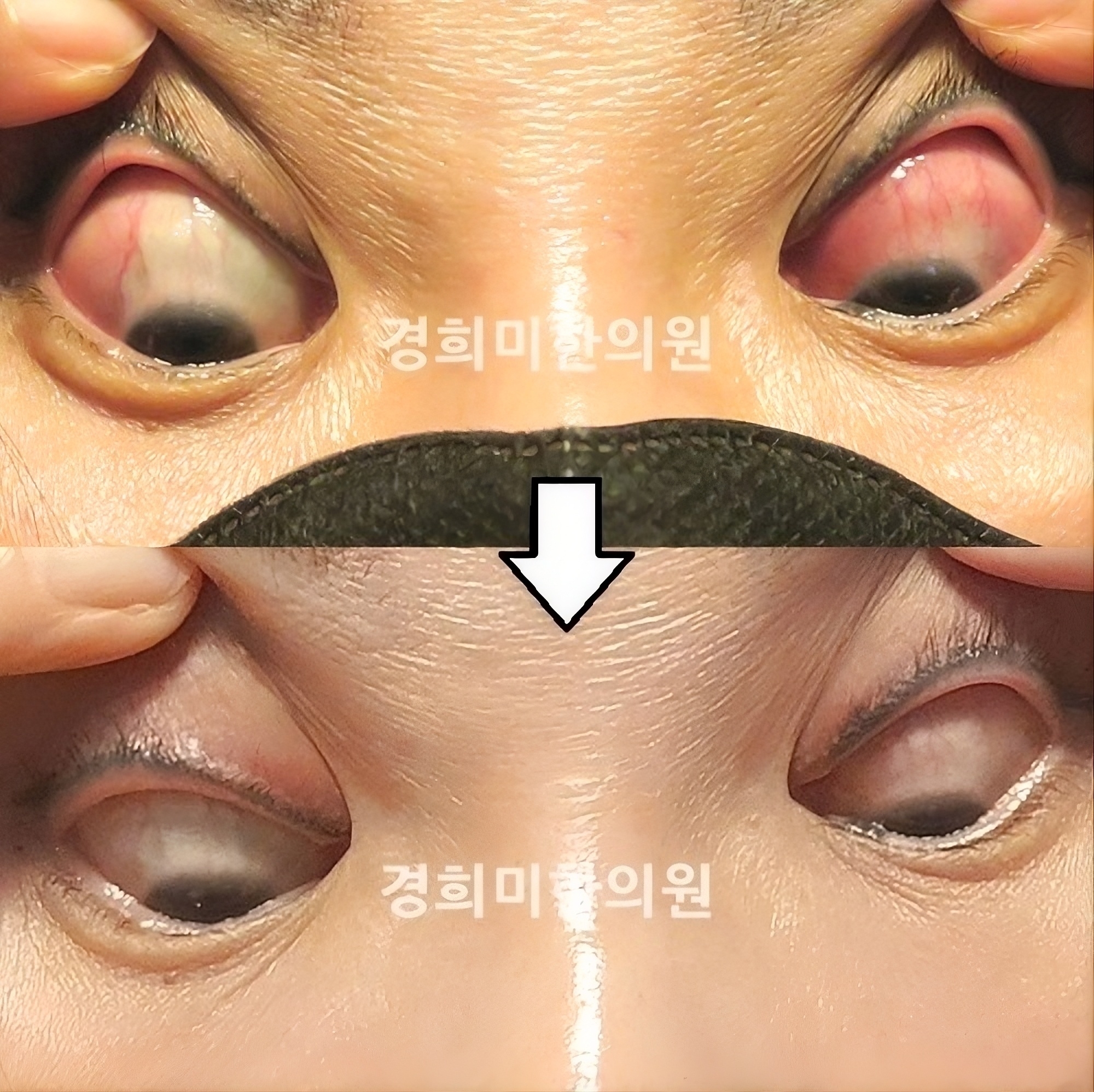 공막염 김태연1.jpg