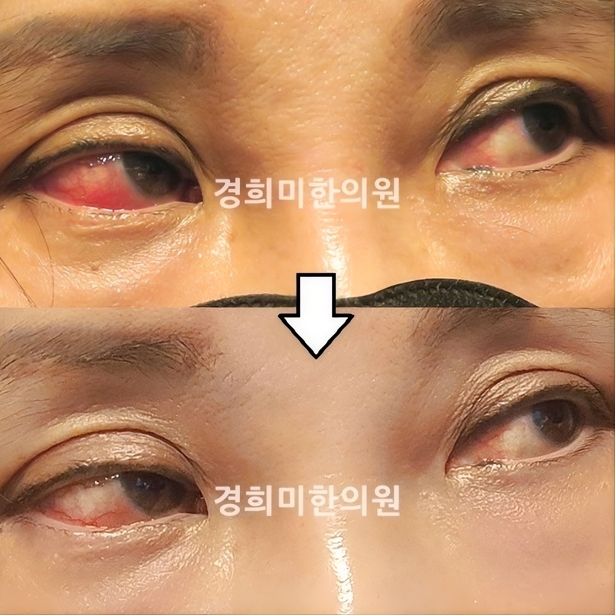 공막염 김태연2.jpg