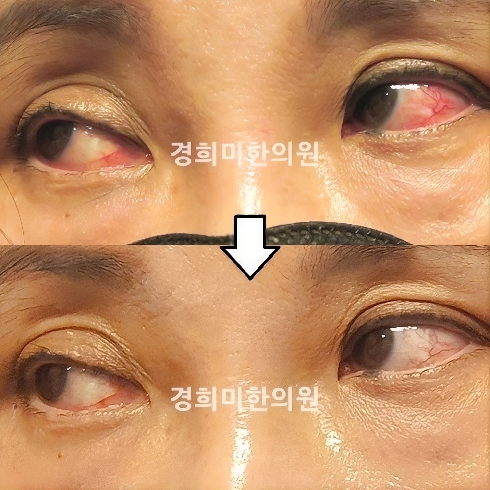 공막염 김태연3.jpg