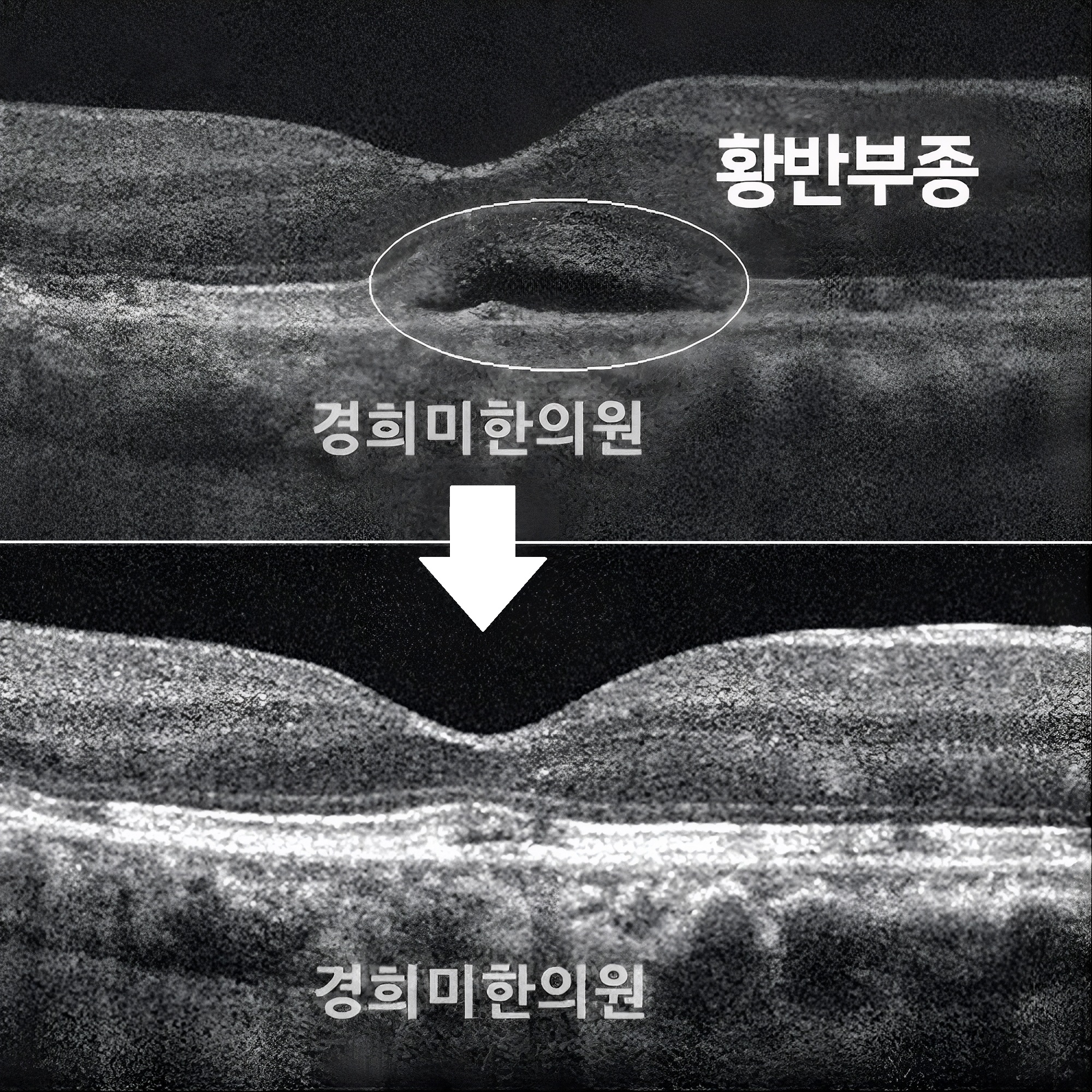 7-황반변성 조용수(우안).jpg