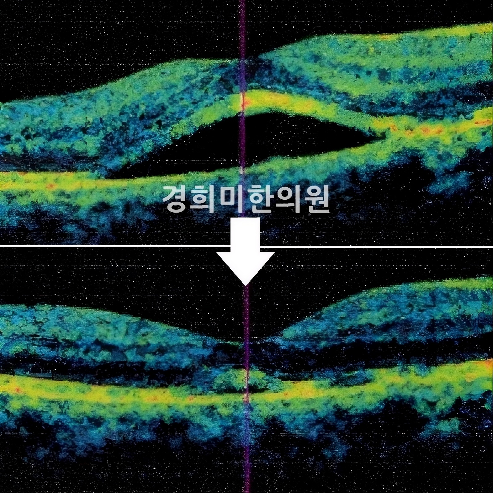 중심성망막염 지남진, 좌안을 우안으로.jpeg