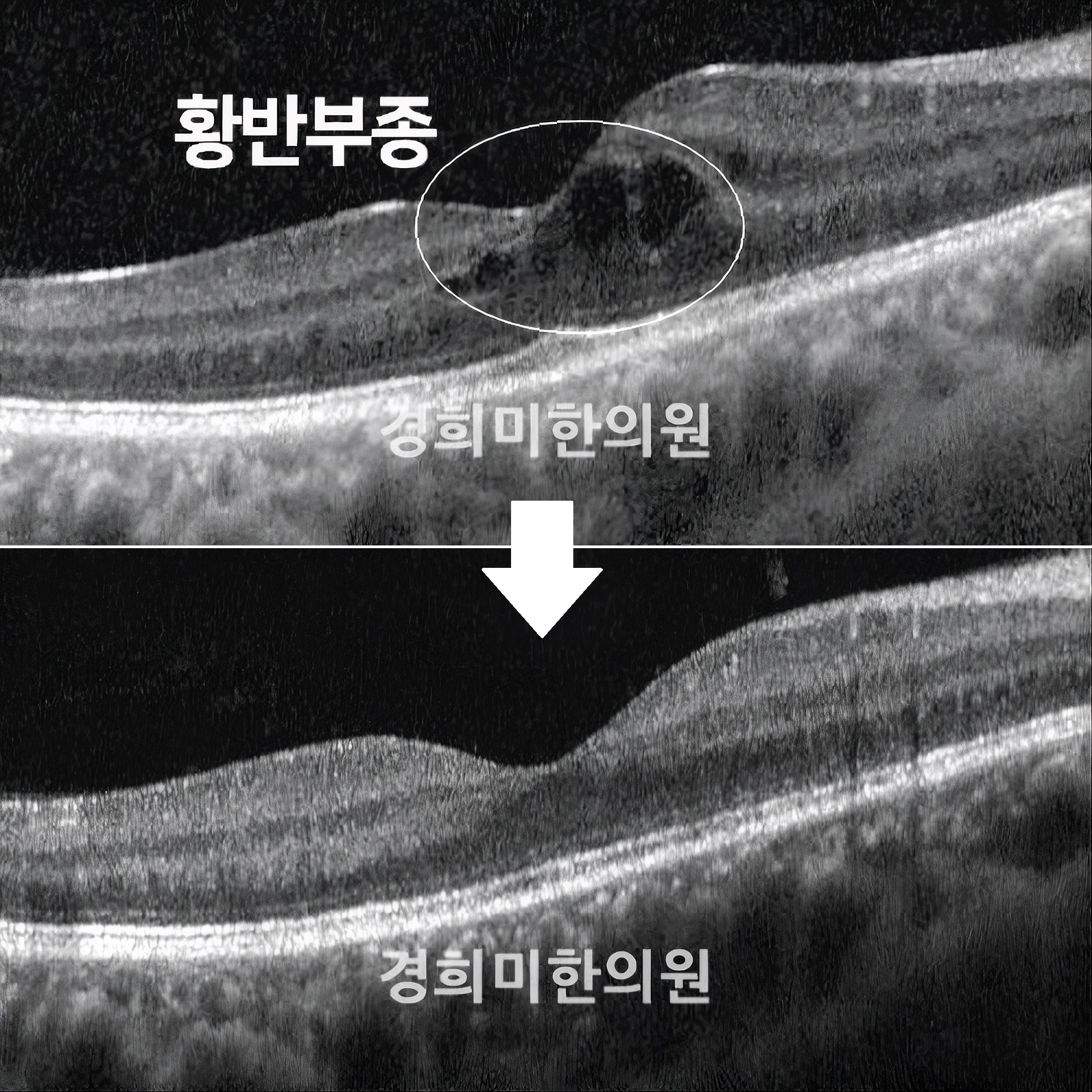 9-황반부종 이정하2(우안).jpg