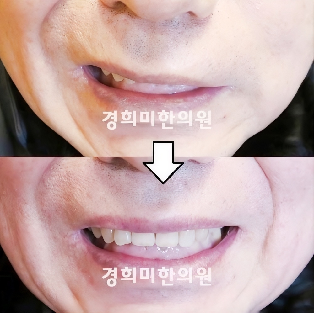 52번-14307-안면마비3차발병.jpg